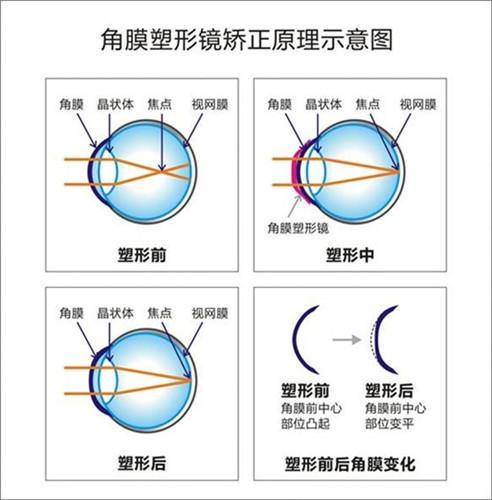 最新近视眼治疗方法，开启视界新篇章